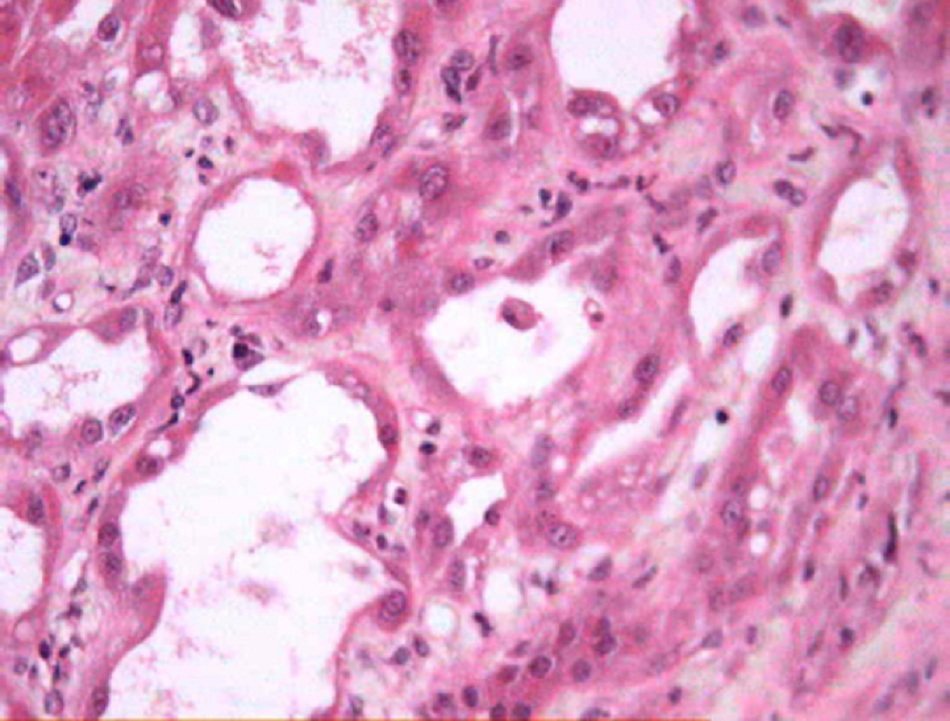 Hình 1: Màng đáy bị bong tróc và có tế bào trong lòng ống thận