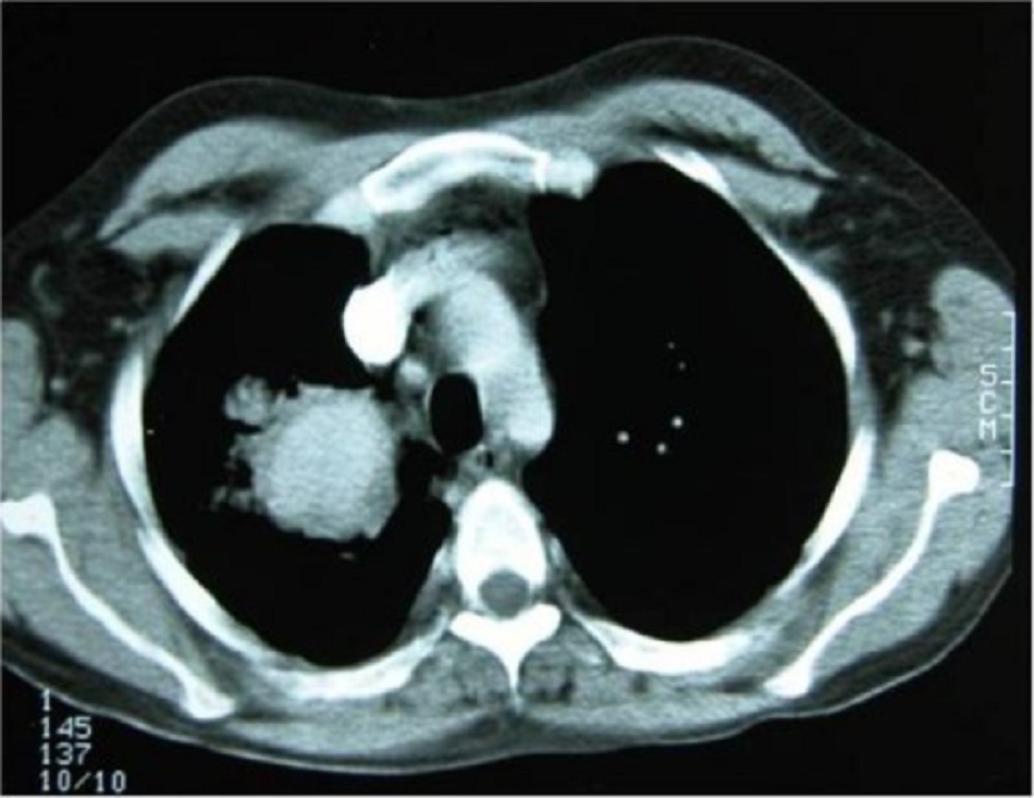 Hình 4: Phình mạch phổi