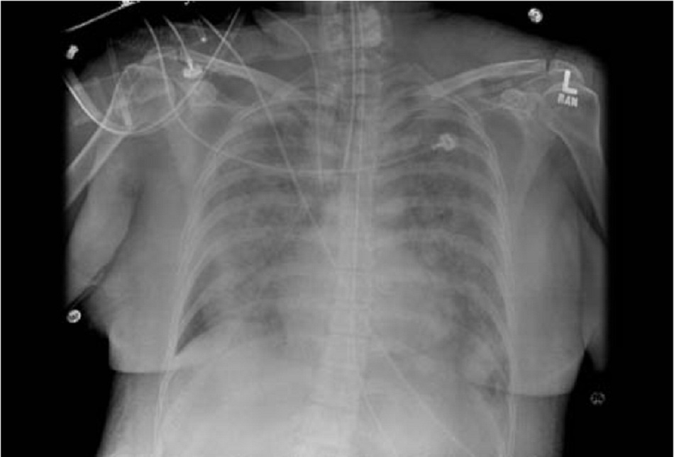 Hình 1: Hình ảnh thâm nhiễm hai phổi trên X-quang ở bệnh nhân ARDS 