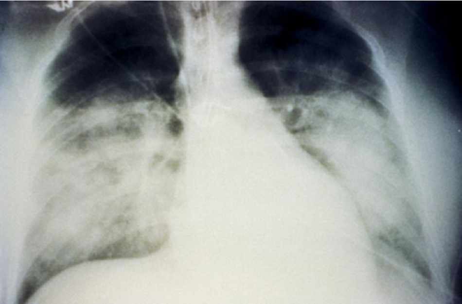 Hình 2: Thâm nhiễm phổi dạng bông ở hai bên trong hội chứng phổi do Hantavirus 