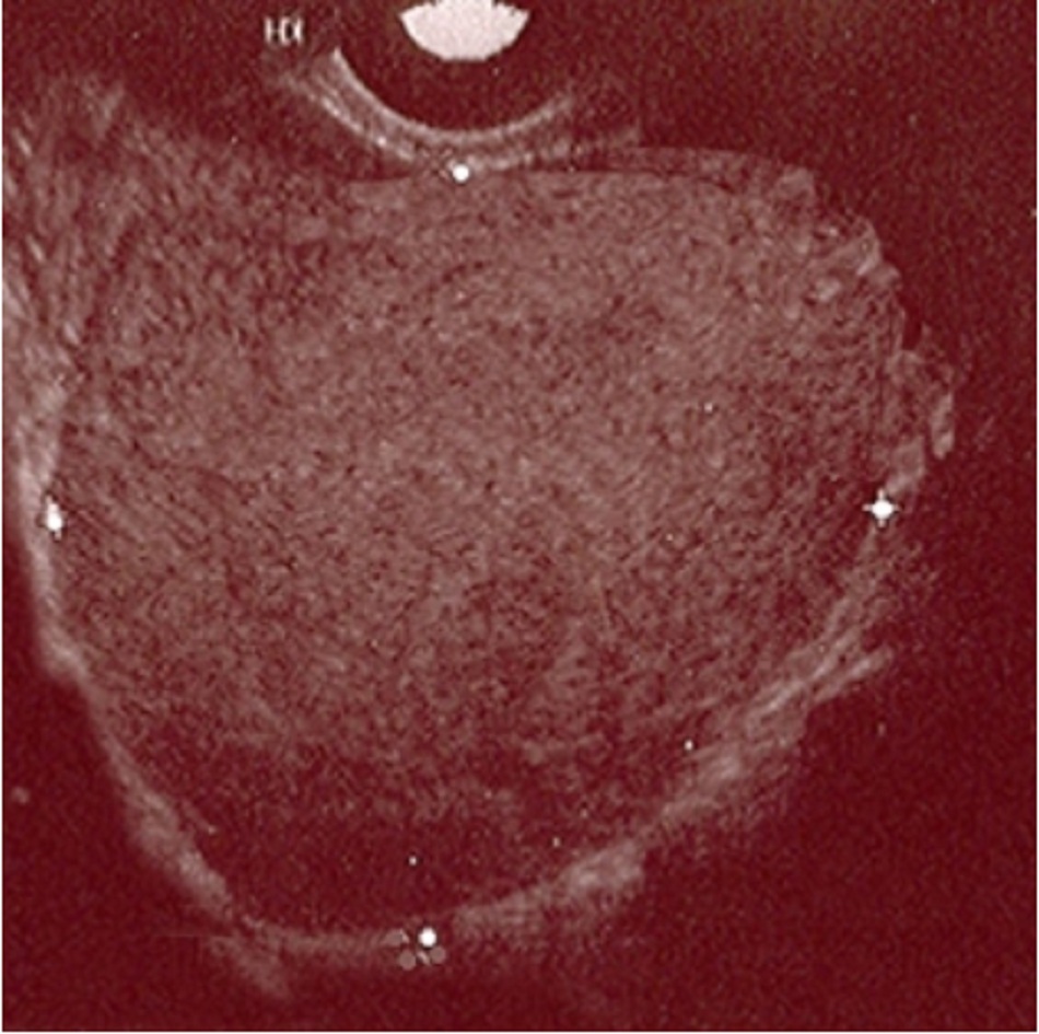 Hình 1: Siêu âm u nội mạc tử cung buồng trứng