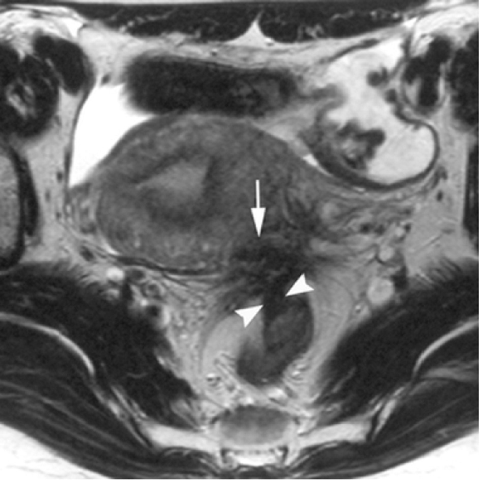 Hình 2: MRI - các nốt xơ hóa ảnh hưởng đến dây chằng tử cung và thành trực tràng