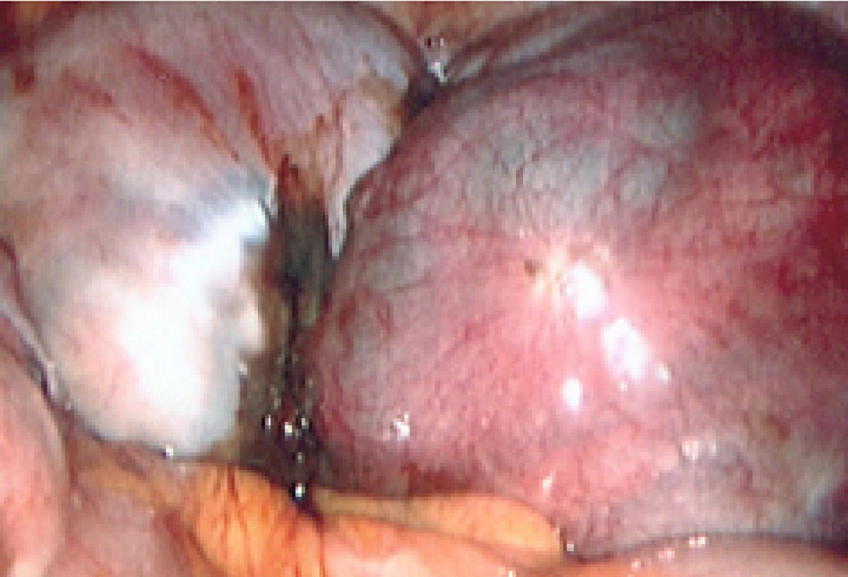 Hình 3: Hình ảnh nội soi ổ bụng của u nội mạc tử cung buồng trứng