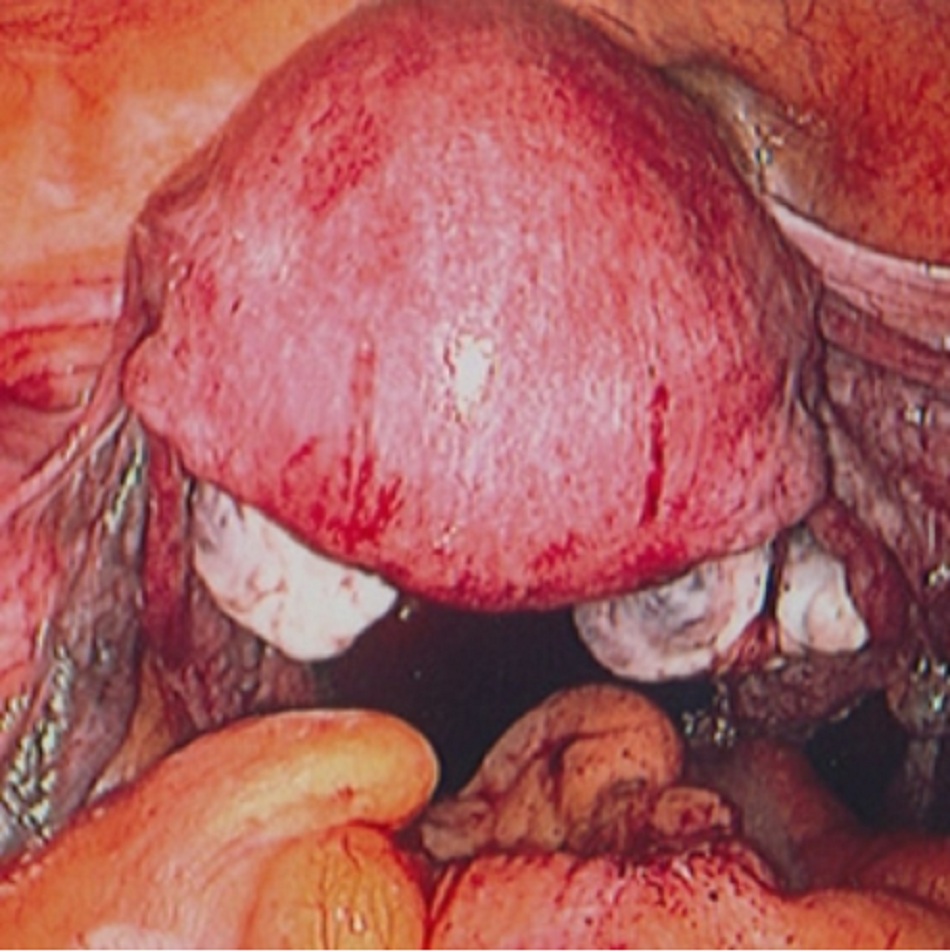 Hình 6: Hình ảnh nội soi ổ bụng của tử cung ngả ra sau
