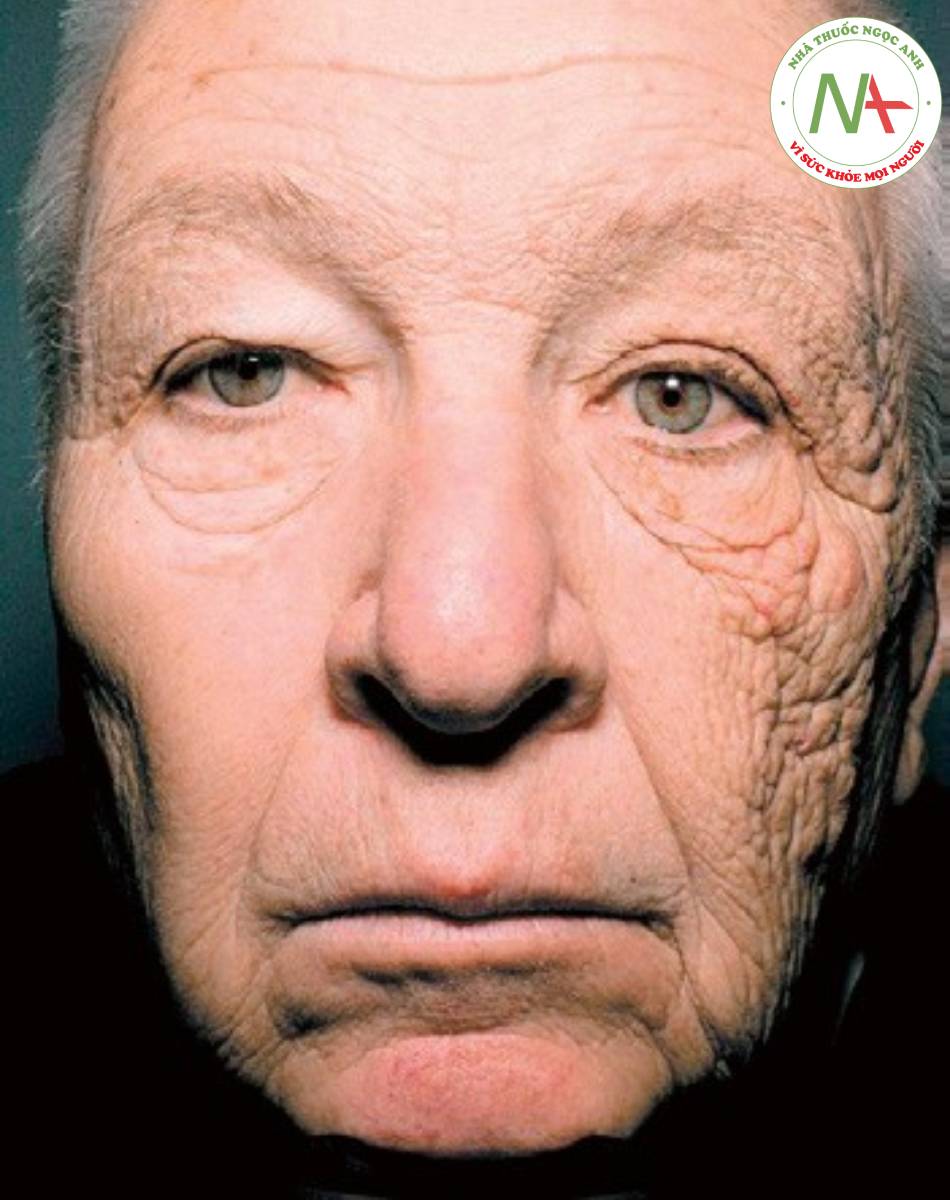 Nam 69 tuổi bị lão hóa da do ánh nắng ở bên mặt trái nhiều hơn mặt phải do 28 năm lái xe tải hằng ngày (đi trên cung đường ánh nắng chiếu vào cabin bên trái nhiều hơn).