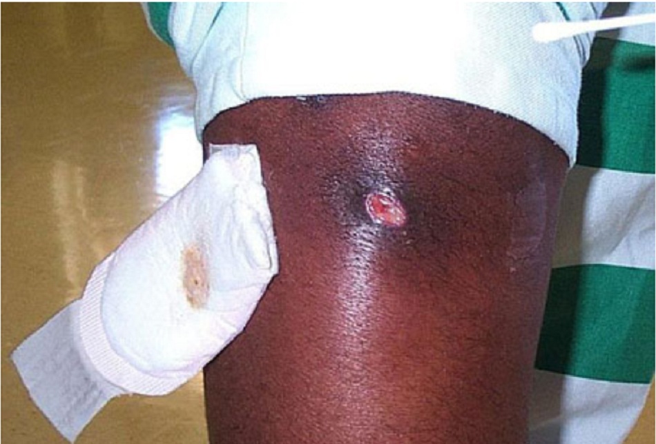 Hình 1: Tổn thương da loét phổ biến thứ phát sau MRSA trên cánh tay của bệnh nhân