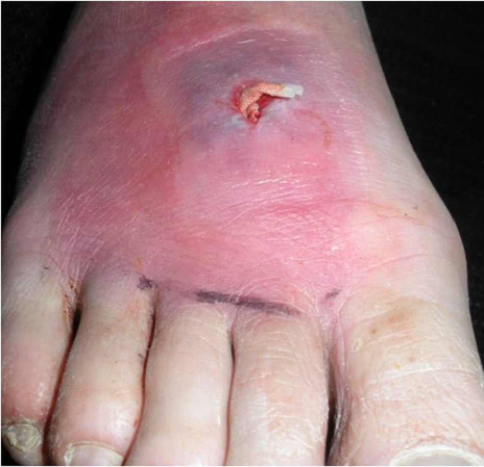 Hình 4: Áp xe da ở bàn chân sau đóng gói do MRSA (nhìn từ trước)