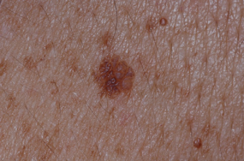 Hình 6: Hình ảnh lâm sàng của dày sừng tiết bã trên lưng của một bệnh nhân nam 40 tuổi