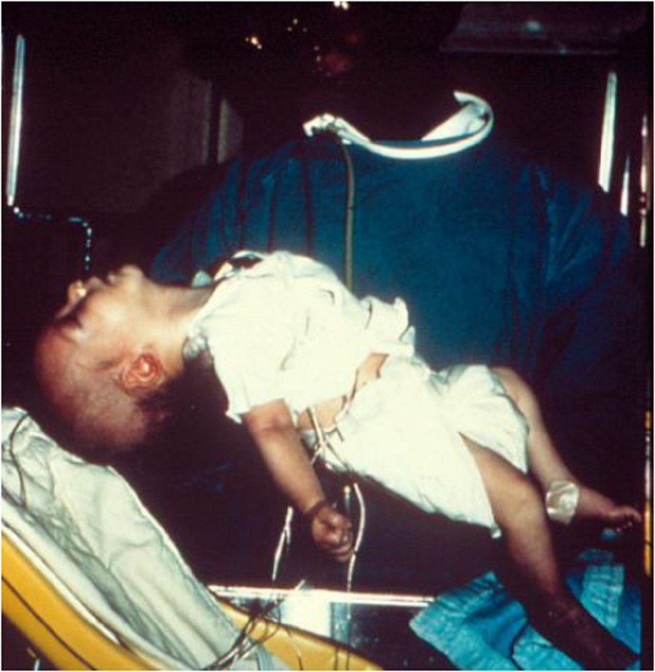 Hình 1: Trẻ nhũ nhi sáu tuần tuổi bị ngộ độc botulism 
