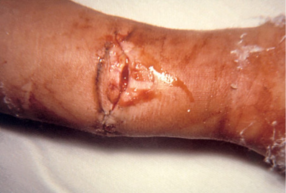 Hình 2: Ngộ độc botulism do vết thương liên quan đến gãy xương phức tạp ở tay phải