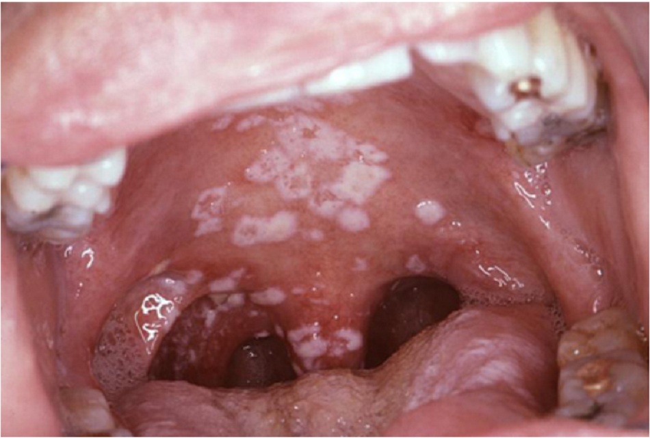 Hình 1: Nhiễm nấm Candida miệng ở bệnh nhân HIV 