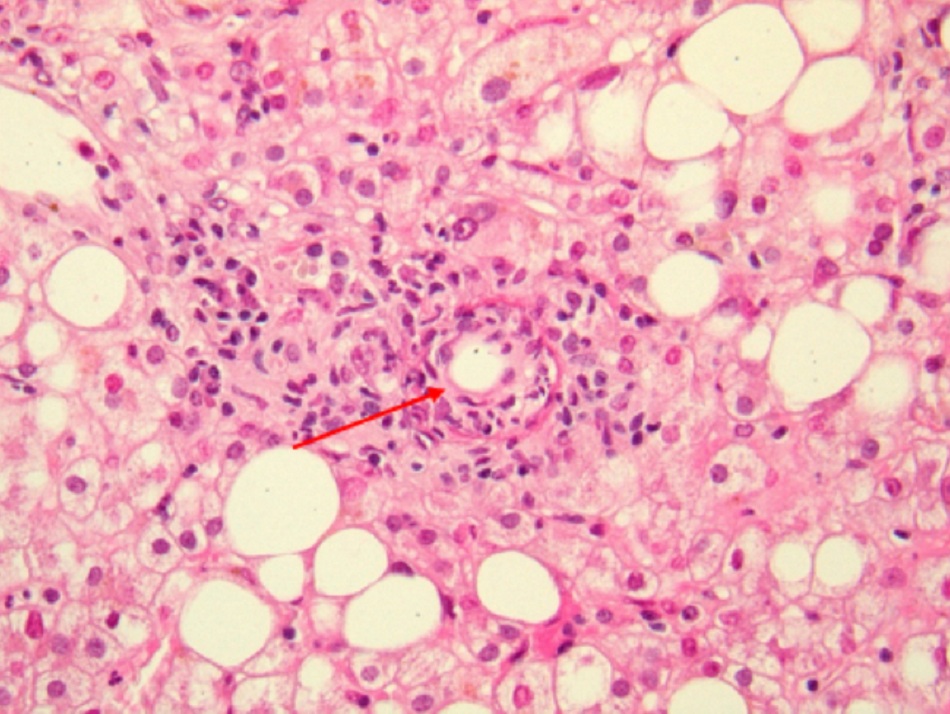 Hình 1: 'U hạt hình bánh doughnut' trong gan đặc trưng của viêm gan do vi khuẩn Coxiella burnetii cấp tính. Lưu ý u hạt có hình thái đặc trưng là bánh doughnut. Không thể phát hiện thấy vi khuẩn nào trong u hạt này
