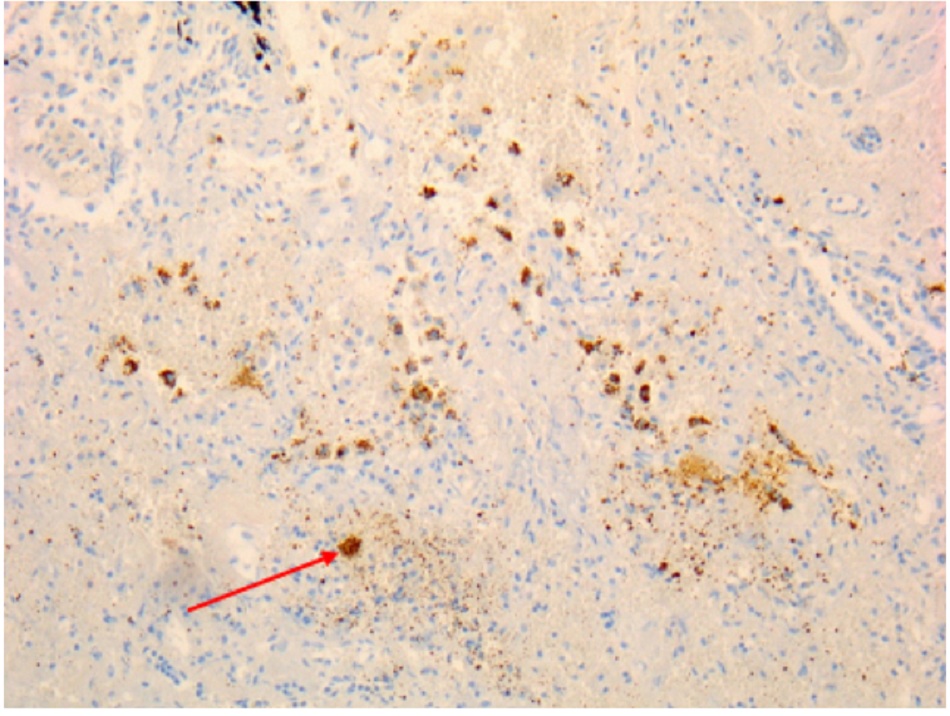 Hình 10: Xơ hóa phổi do vi khuẩn Coxiella burnetii: hóa mô miễn dịch; màu nâu chỉ rõ vi khuẩn trong bạch cầu đơn nhân/ đại thực bào
