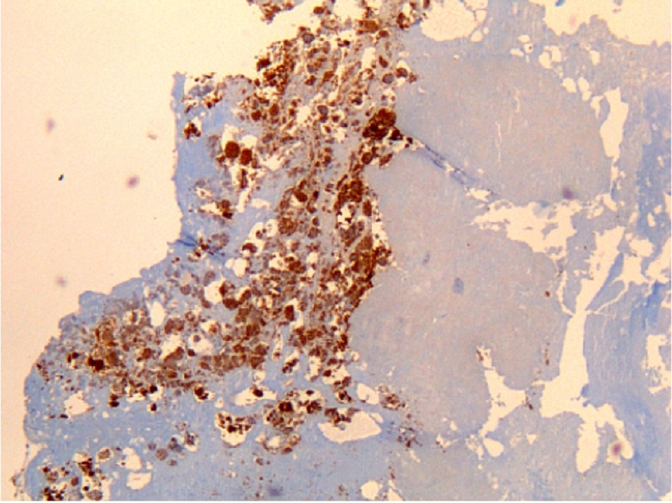 Hình 11: Viêm nội mạc tim do vi khuẩn Coxiella burnetii: hóa mô miễn dịch. Nhận thấy mức độ viêm thấp. Màu nâu chỉ rõ vi khuẩn trong bạch cầu đơn nhân/đại thực bào bên trong. Thường không có nốt sùi