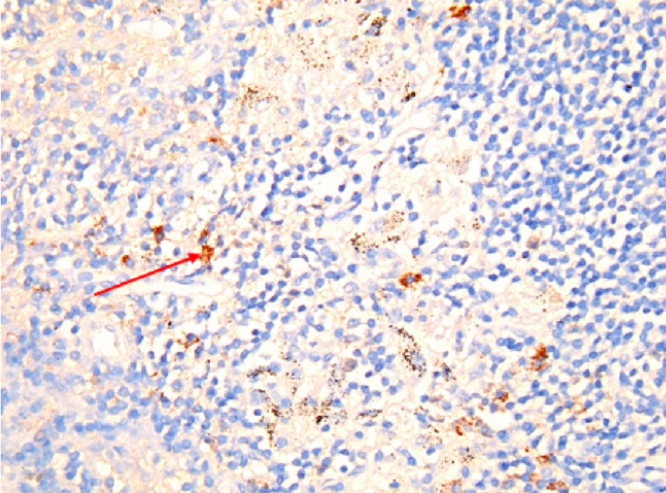 Hình 12: Viêm hạch bạch huyết mạn tính do vi khuẩn Coxiella burnetii: hóa mô miễn dịch. Nhận thấy tế bào nhiễm bệnh cô lập (bạch cầu đơn nhân/đại thực bào) trong hạch bạch huyết. Màu nâu chỉ rõ vi khuẩn trong bạch cầu đơn nhân/đại thực bào