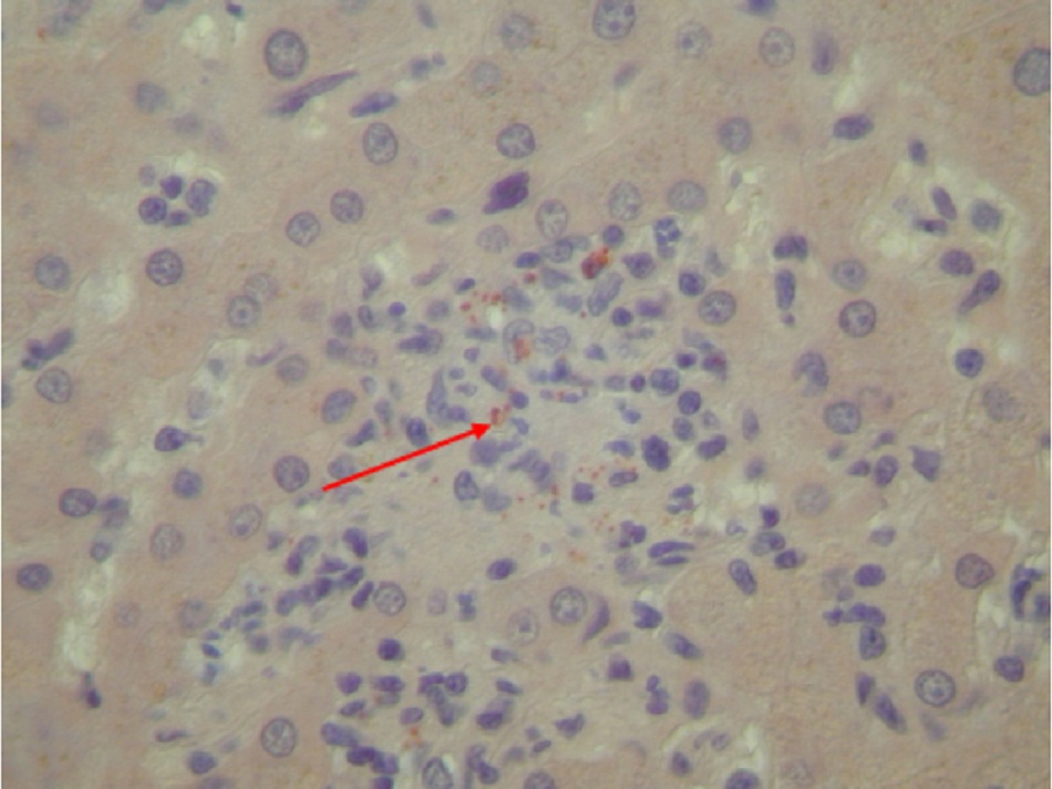 Hình 13: Viêm gan mạn tính do vi khuẩn Coxiella burnetii ở bệnh nhân viêm nội mạc tim: hóa mô miễn dịch. Nhận thấy không tìm thấy u hạt hình bánh doughnut khi bị sốt Q cấp tính. Màu nâu chỉ rõ vi khuẩn trong bạch cầu đơn nhân/đại thực bào