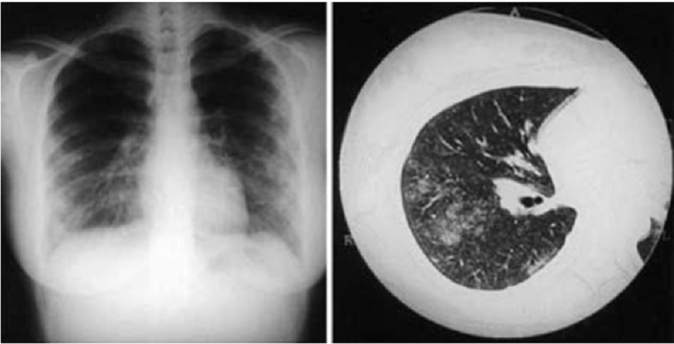 Hình 5: Viêm phổi do vi khuẩn Coxiella burnetti. X-quang ngực thẳng và chụp CT một phụ nữ 21 tuổi bị viêm phổi do vi khuẩn Coxiella burnetii; X-quang ngực thẳng cho thấy nhiều vùng đông đặc mềm ở trường phổi từ giữa đến dưới hai bên; chụp CT cho thấy hạch dưới trung tâm tiểu thùy và vùng thông khí đông đặc không được xác định rõ.