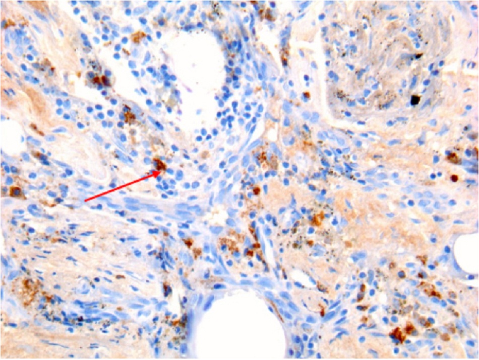 Hình 9: Viêm xương khớp do vi khuẩn coxiella burnetii: hóa mô miễn dịch: màu nâu chỉ rõ vi khuẩn trong bạch cầu đơn nhân/đại thực bà