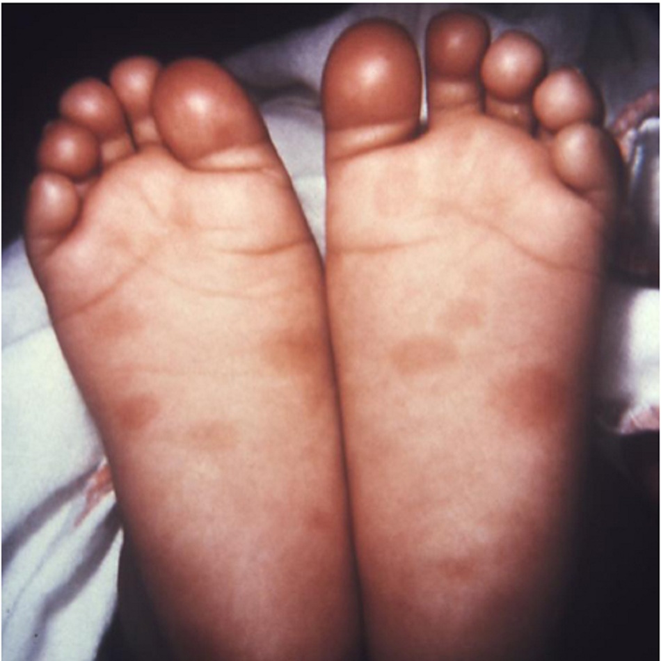 Hình 10: Trẻ sơ sinh này biểu hiện các triệu chứng của bệnh giang mai bẩm sinh, bao gồm các tổn thương trên lòng bàn chân ở cả hai chân