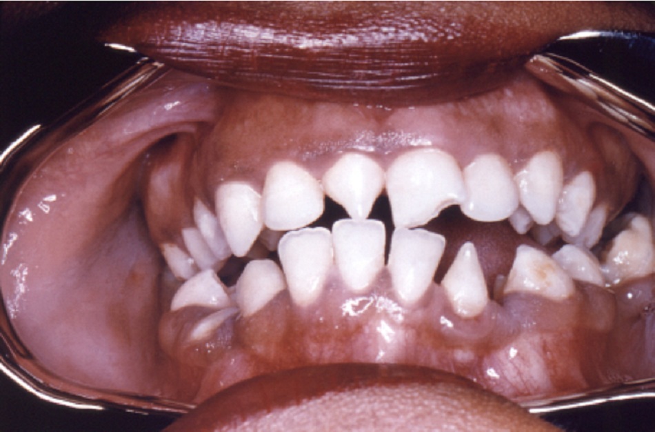Hình 12: Răng cửa giữa hình chêm, có vết lõm (răng Hutchinson) 