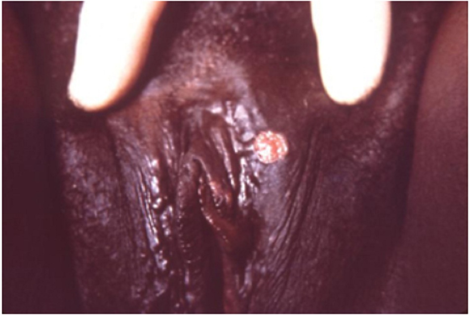 Hình 2: Săng giang mai âm hộ giai đoạn I do vi khuẩn Treponema pallidum 