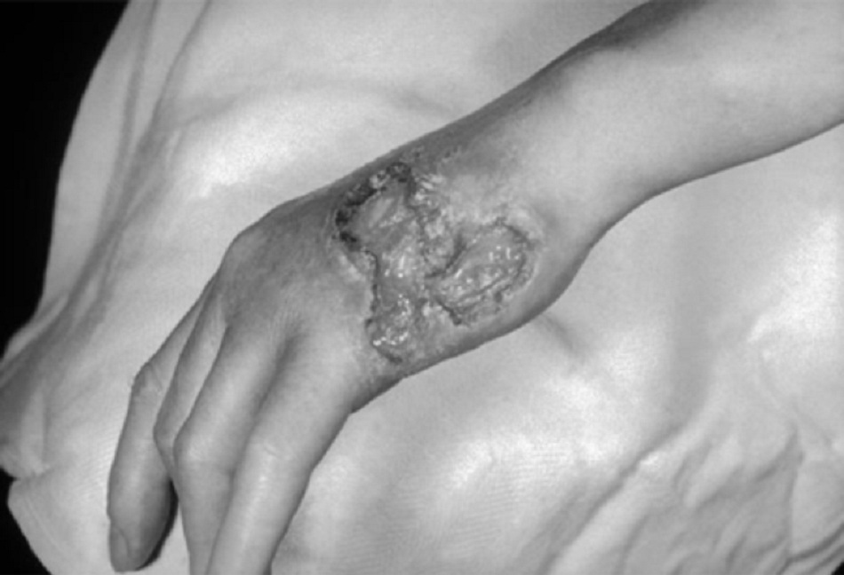 Hình 4: Các tổn thương gôm trên mu bàn tay trái 