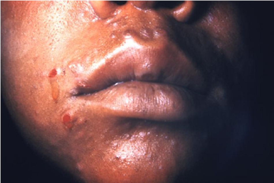 Hình 6: Tổn thương của giang mai giai đoạn II trên mặt 
