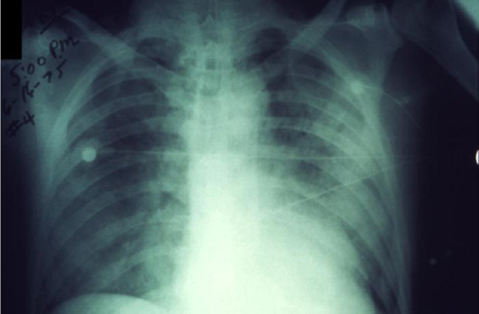 Hình 4: Nhiễm bệnh dịch hạch liên quan đế cả hai lá phổi