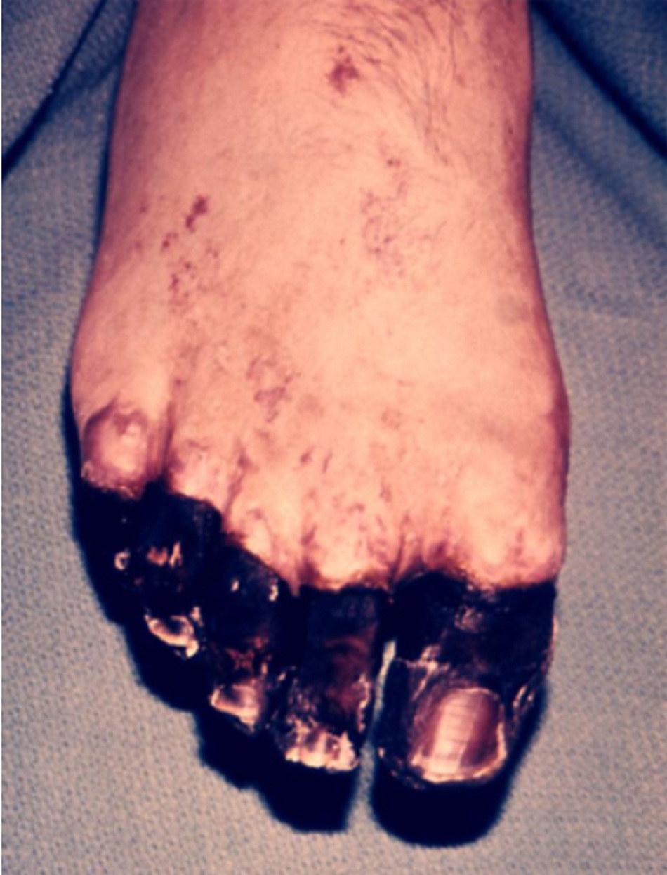 Hình 5: Hoại thư bàn chân phải gây hoại tử ngón chân