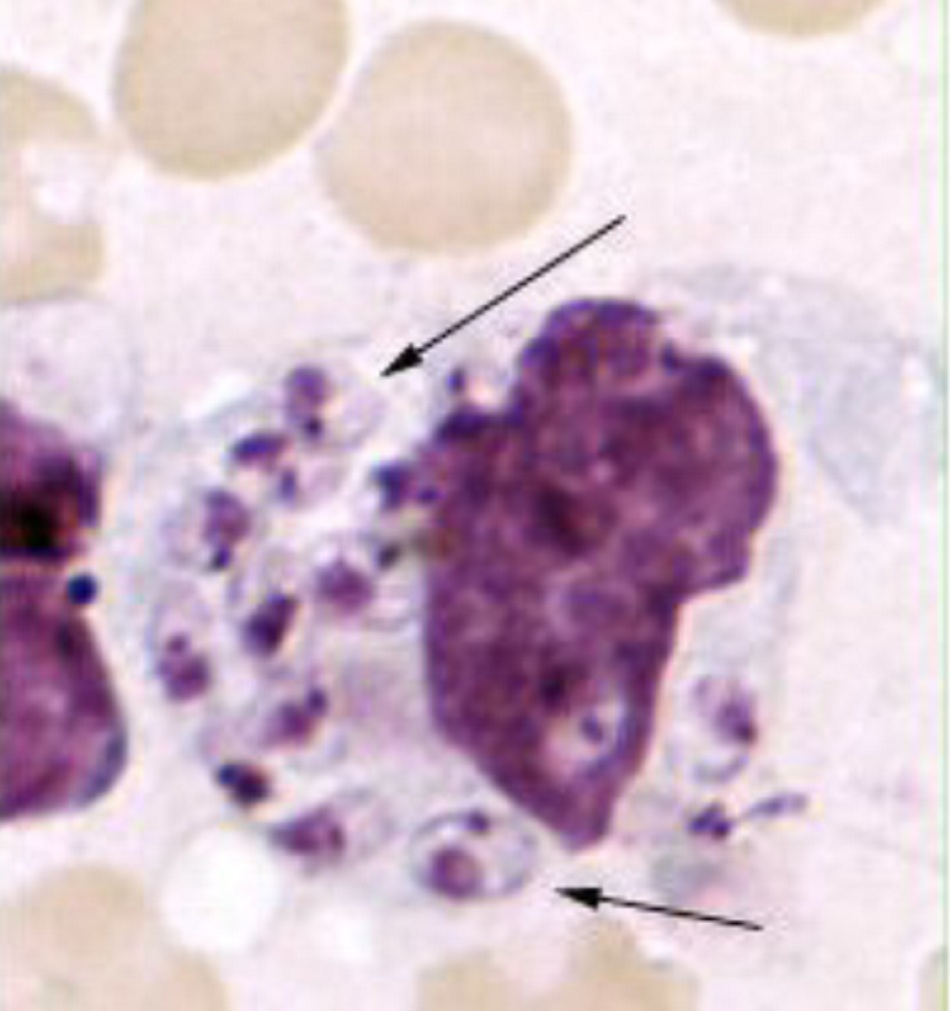 Hình 2: Soi tổn thương da thấy thể amastigote của Leishmania tropica. Đại thực bào nguyên vẹn thực tế chứa đầy các thể amastigote, trong số đó nhiều đại thực bào có nhân tế bào và nhân động có thể nhìn thấy rõ (mũi tên)