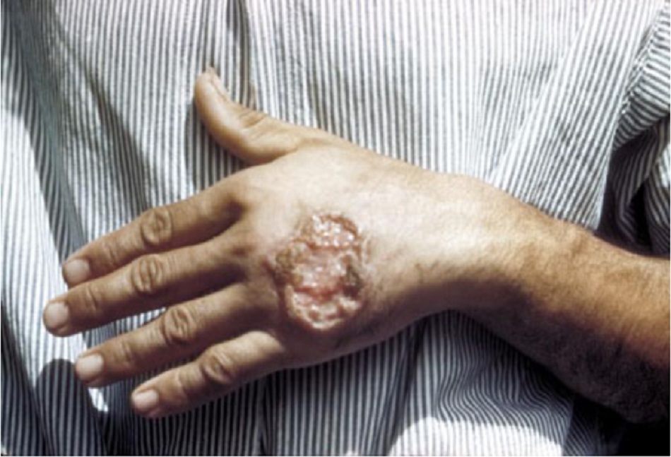 Hình 4: Loét da do bệnh nhiễm Leishmania, bàn tay của người lớn Trung Mỹ