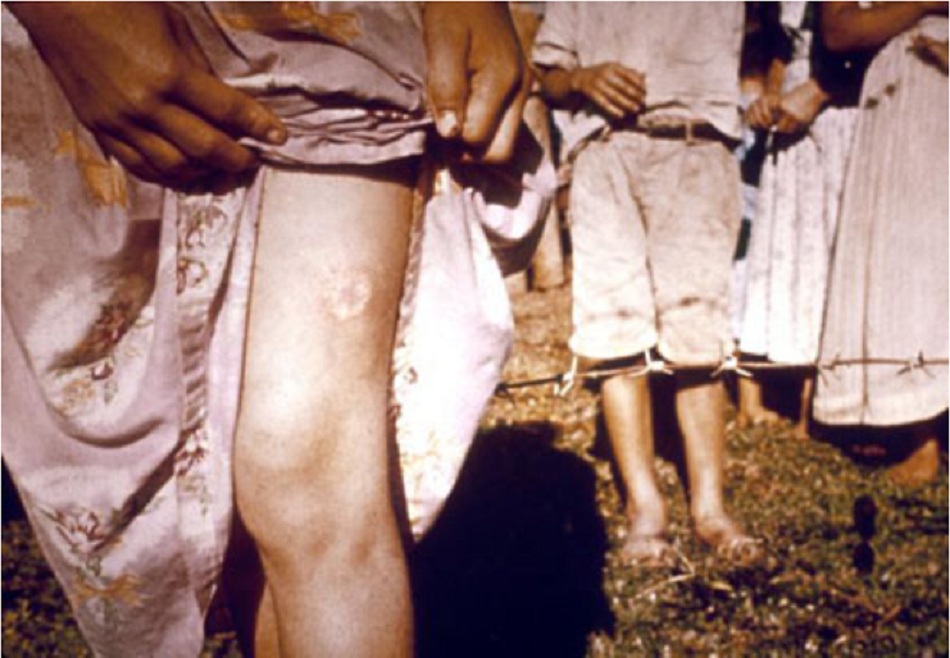 Hình 5: Sẹo trên da đùi từ một tổn thương đã lành của bệnh nhiễm Leishmania