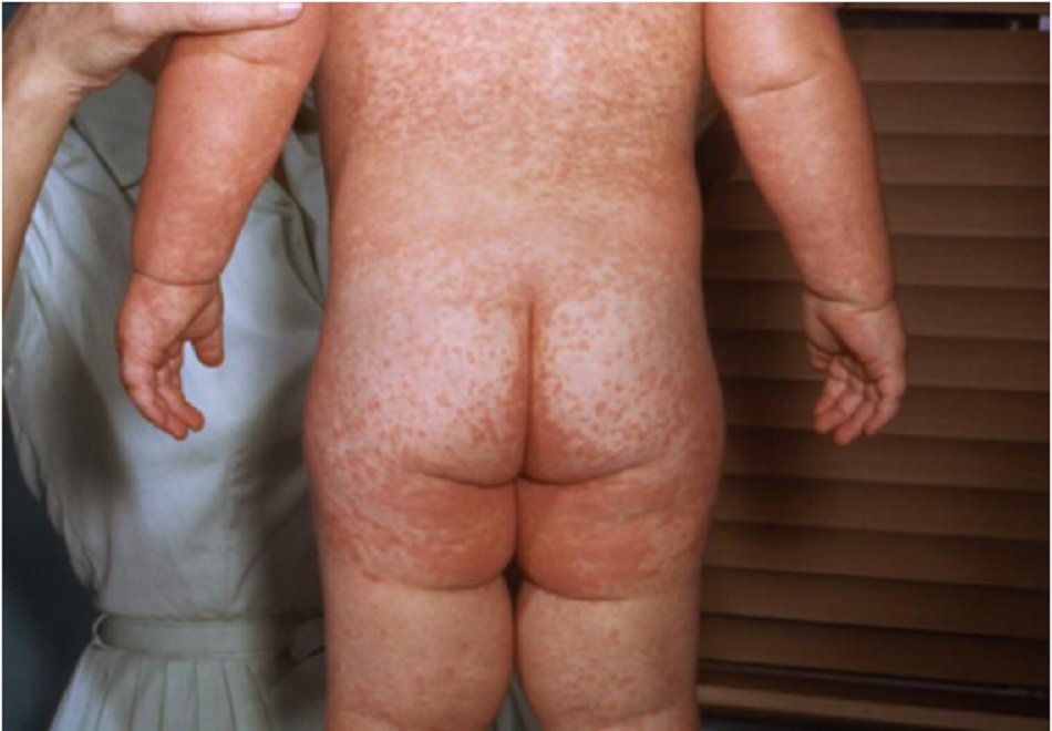Hình 5: Trẻ mắc bệnh sởi xuất hiện phát ban màu đỏ sậm đặc trưng trên mông và lưng vào ngày phát ban thứ ba