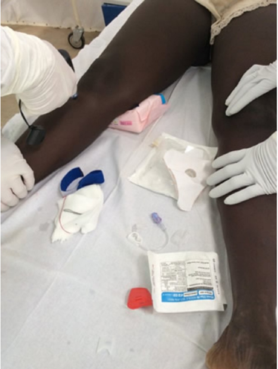 Hình 12: Đặt đường truyền trong xương ở người lớn mắc bệnh vi-rút Ebola nặng (Tây Phi)