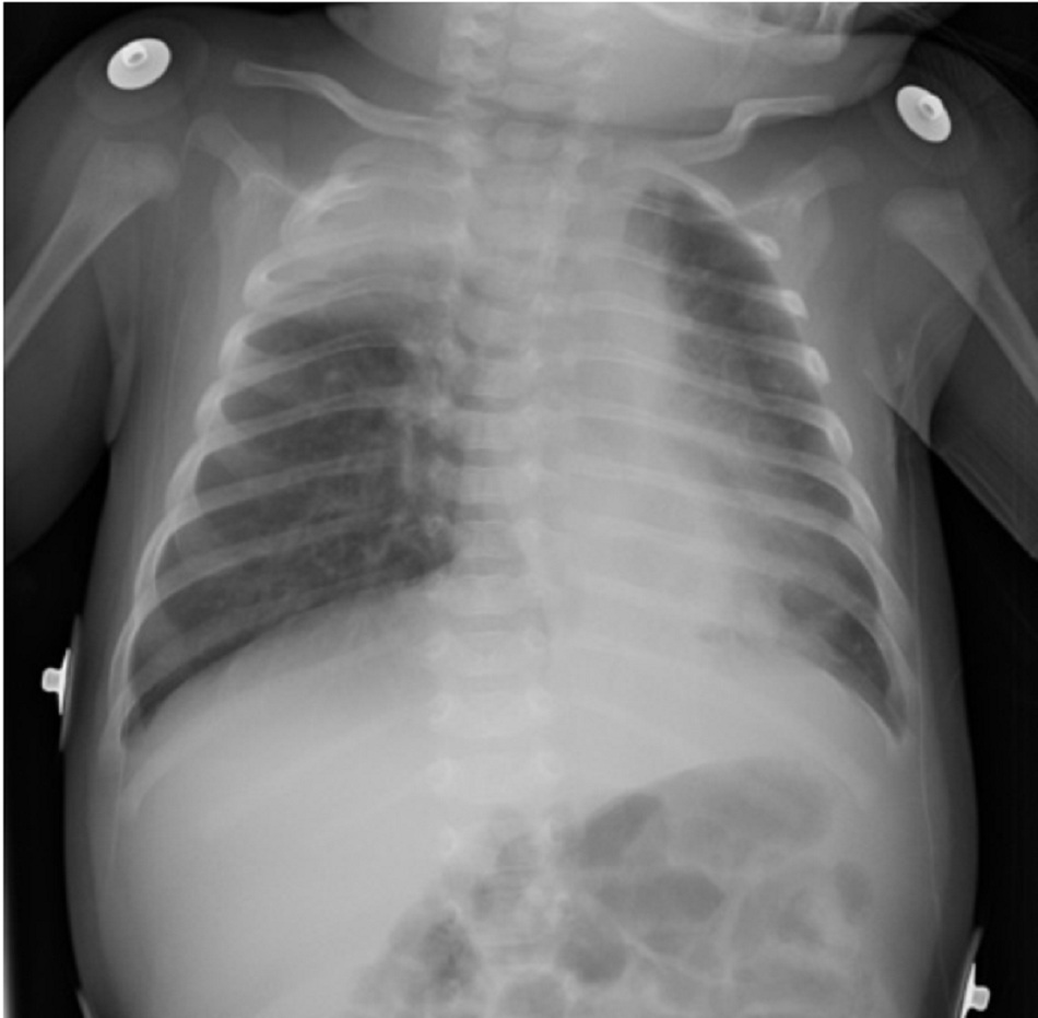 Hình 2: Xẹp phổi