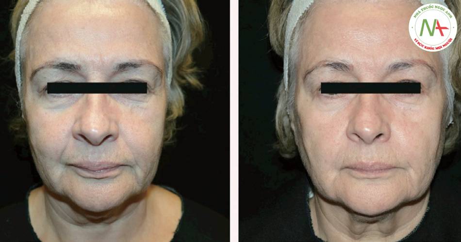 Hình ảnh trước và sau 12 tuần điều trị lão hóa da trong nghiên cứu của hãng DefenAge dùng defensin: cải thiện cả về nếp nhăn, tông da.