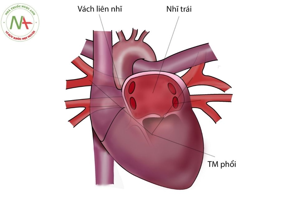 Hình 1. Giải phẫu bình thường của 4 tĩnh mạch phổi