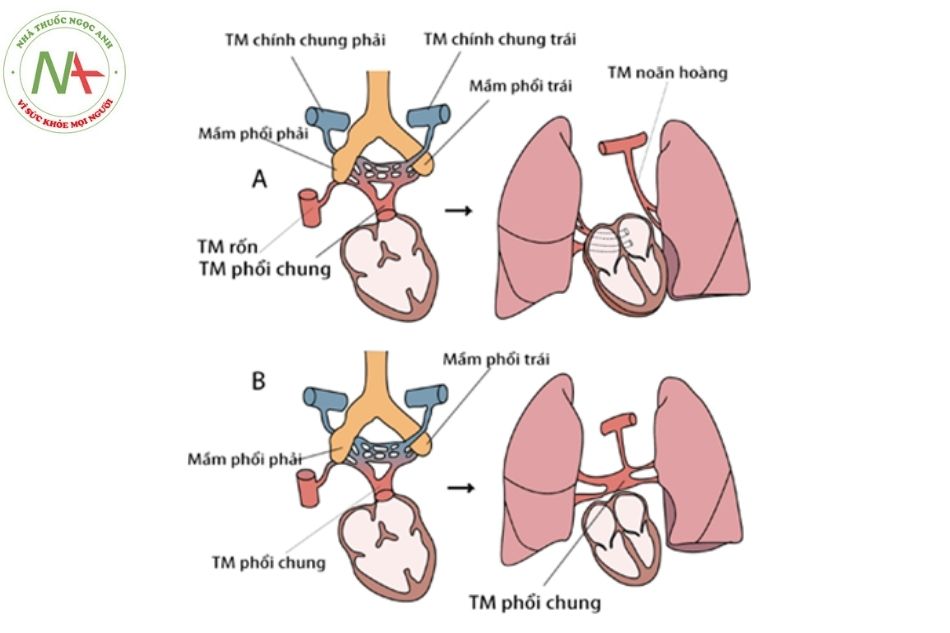 Hình 17. Cơ chế bất thường đổ về tĩnh mạch phổi bán phần