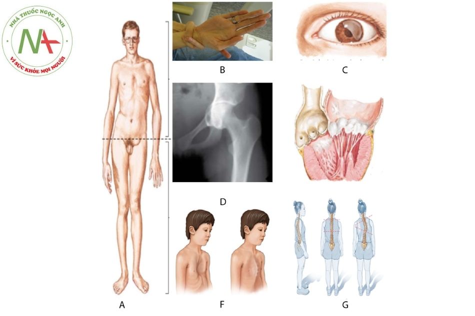 Hình 1. Một số đặc điểm tổn thương trên bệnh nhân hội chứng Marfan