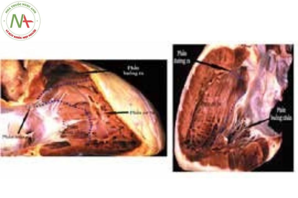 Hình 1. Hình ảnh vách liên thất nhìn từ phía tâm thất phải (bỏ đi thành tự do của tâm thất phải) (Nguồn: Echocardiography in Pediatric and Congenital Heart Disease)