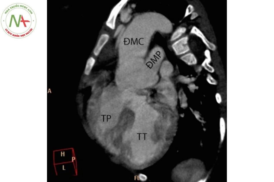 Hình 10. Hình ảnh chụp cắt lớp vi tính tim ở bệnh nhân có thân chung động mạch