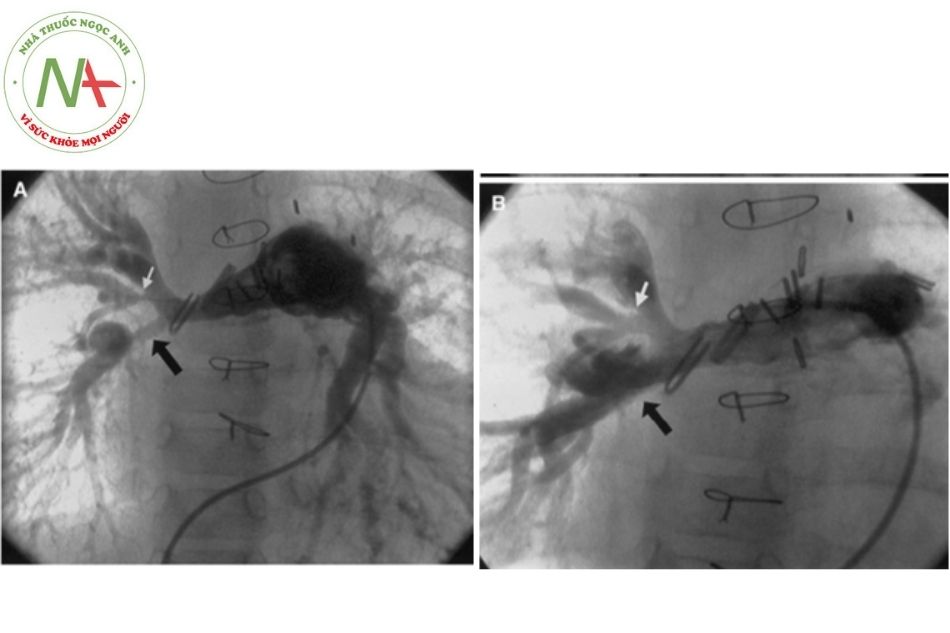 Hình 10. Hình ảnh chụp động mạch phổi trước (A) và sau (B) nong bóng chỗ hẹp ở thời điểm 2 năm sau mổ đơn nguồn hóa không kèm đóng lỗ thông liên thất. Các chỗ hẹp ở thùy giữa (mũi tên trắng) và thùy dưới (mũi tên đen) đã được nong thành công.