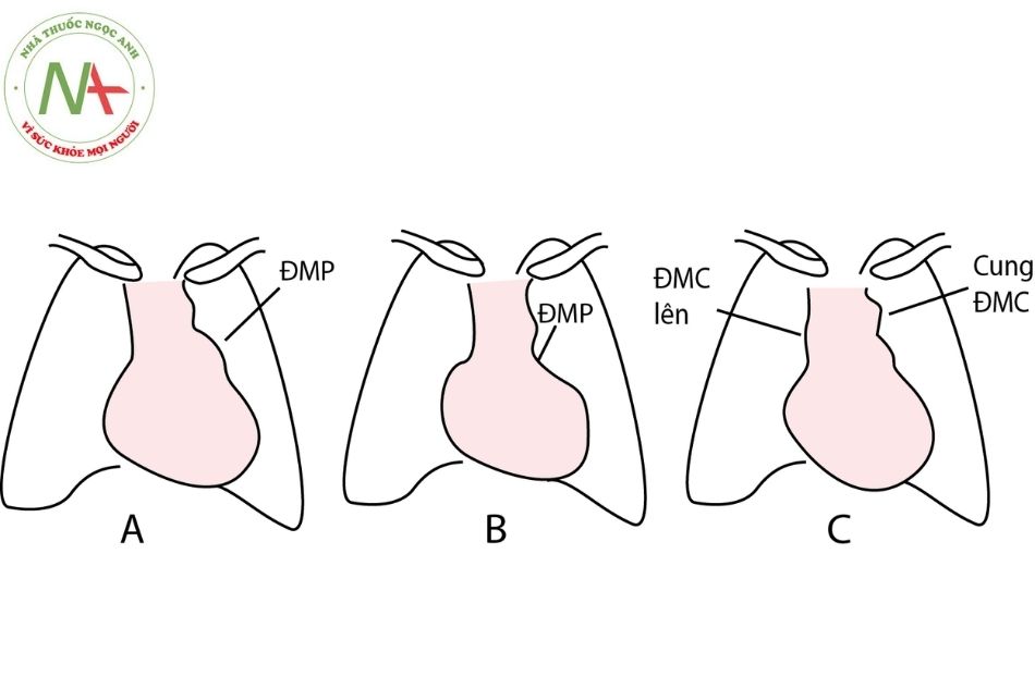 Hình 10. Hình ảnh minh họa các bất thường động mạch lớn trên phim Xquang (A). Cung ĐMP nổi; (B) Cung ĐMP lõm