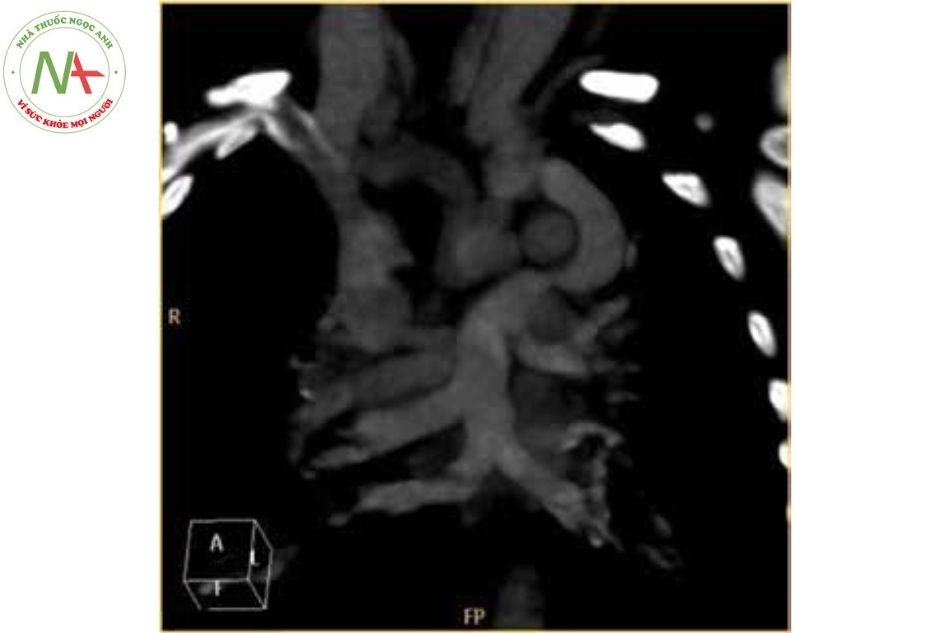 Hình 11. Hình ảnh chụp cắt lớp vi tính ở bệnh nhân có bất thường đổ về tĩnh mạch phổi toàn phần thể trên tim
