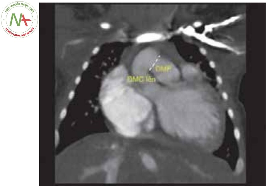 Hình 11. Hình ảnh CT cho thấy cửa sổ chủ phế type II giữa động mạch chủ lên và chạc ba động mạch phổi Chú thích: ĐMC: Động mạch chủ; ĐMP: Động mạch phổi.