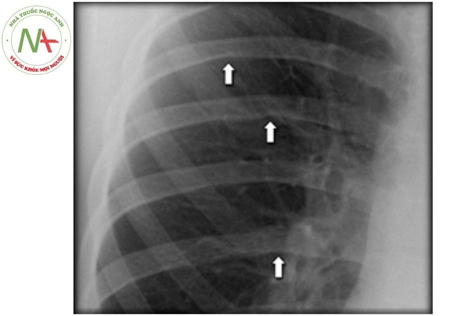 Hình 11. Hình ảnh khuyết xương sườn trên phim Xquang ngực thẳng (ở bệnh nhân có hẹp eo động mạch chủ)