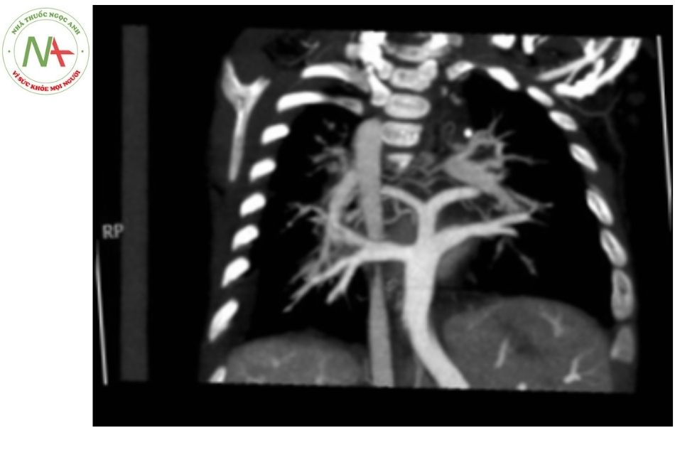 Hình 12. Hình ảnh chụp cắt lớp vi tính ở bệnh nhân có bất thường đổ về tĩnh mạch phổi toàn phần thể dưới tim