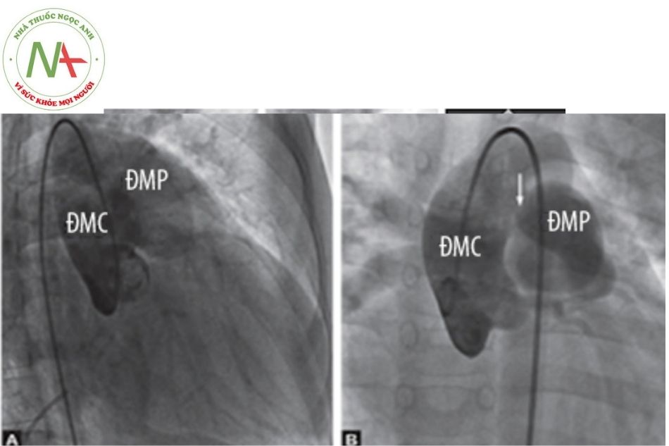 Hình 12. A. Chụp động mạch chủ lên hướng chếch trước phải cho thấy hình ảnh thuốc cản quang trong động mạch phổi qua cửa sổ chủ phế (type III) với động mạch phổi giãn; B. Chụp gốc động mạch chủ theo chiều trước sau cho thấy hình ảnh cản quang trong động mạch phổi qua cửa sổ chủ phế type II.
