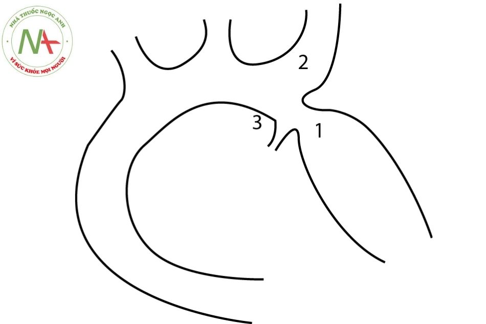 Hình 10.12. Hình “số 3” trên phim Xquang ngực tia cứng Hình vẽ mô tả hẹp eo ĐMC khu trú (1) ngay sau gốc xuất phát của ĐM dưới đòn trái (2) và dây chằng động mạch (3). Đường bờ của ĐMC bị biến dạng thành hình “số 3’’ do giãn cả trước và sau, và giãn ĐM dưới đòn trái.