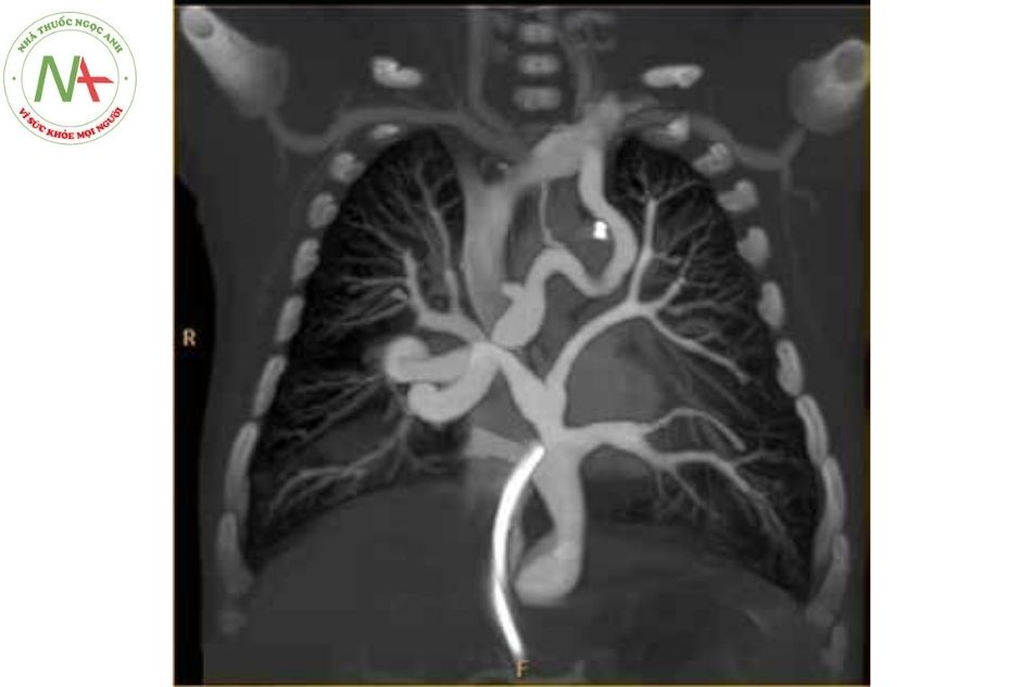 Hình 13. Hình ảnh chụp cắt lớp vi tính ở bệnh nhân có bất thường đổ về tĩnh mạch phổi toàn phần thể hỗn hợp